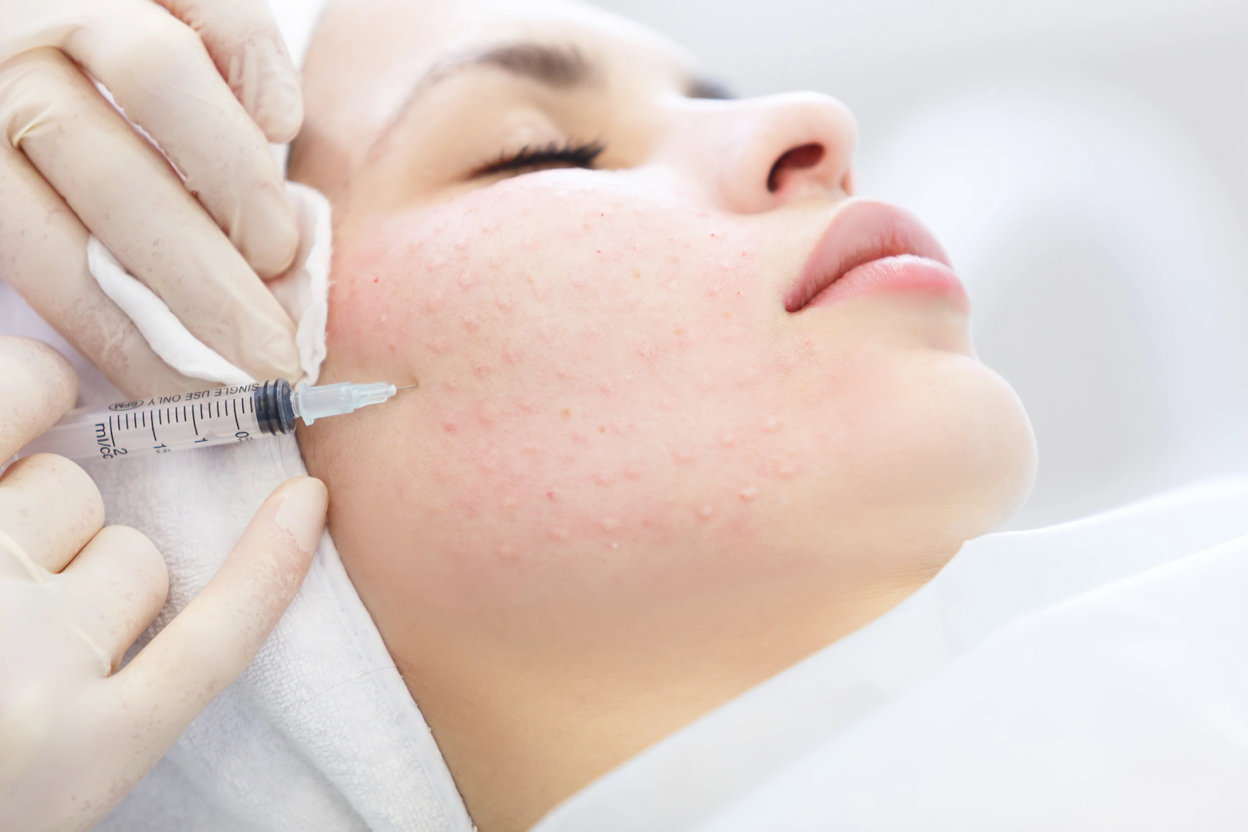Radiant Renewal: Mesotherapy & Skin Boosters